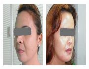 cosmetic surgery noselift eyebag lipo facelift eyelid -- Spa Care Services -- Metro Manila, Philippines