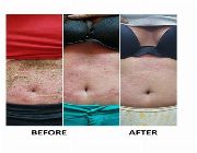 Psoriasis, skin diseases, acne, eczema, an-an, ring worm. dermatitis -- Networking - MLM -- Metro Manila, Philippines
