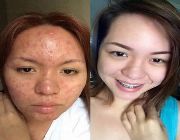 Whitening -- Beauty Products -- Agusan del Norte, Philippines