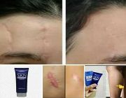 scar removal cream, SKN White cream, alternative to hydroquinone, skin lightener, freckles, dark spots, melasma -- Beauty Products -- Pangasinan, Philippines