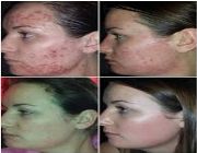 scar remover cosmetics acne scar remover 90 -- All Beauty & Health -- Metro Manila, Philippines
