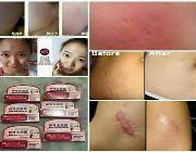 scar remover -- Natural & Herbal Medicine -- Bacoor, Philippines