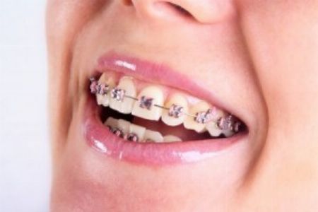 Dental braces -- Doctors & Clinics -- Mandaluyong, Philippines
