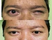 Custom Made Artificial Eye Manila Philippines -- Doctors & Clinics -- Metro Manila, Philippines