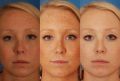 photofacial skin rejuvination anti aging wrinkle removal skin whitening ski, -- Doctors & Clinics -- Paranaque, Philippines