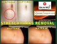 stretchmark remover, scar treatment, dermaroller, microneedling, skin needling -- Distributors -- Bulacan City, Philippines