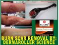 scar remover, scar treatment, dermaroller, skin needling, micro needling -- Distributors -- Bulacan City, Philippines