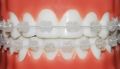 clear braces ceramic dental cubao, -- Medical and Dental Service -- Metro Manila, Philippines