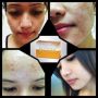 whitening anti acne moisturizer anti aging glutathione papaya kojic, -- Beauty Products -- Cavite City, Philippines