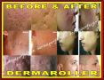 acne scar treatment, pimple scar -- Distributors -- Bulacan City, Philippines