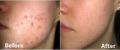 acne therapy back acne pimples facial treatment, -- Doctors & Clinics -- Quezon City, Philippines