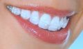 clear braces ceramic dental cubao, -- Medical and Dental Service -- Metro Manila, Philippines