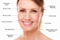 radiofrequency rf facial anti aging face lift skin rejuvenating anti wrinkl, -- Doctors & Clinics -- Quezon City, Philippines