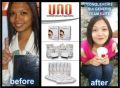 uno, glutathione capsule, whitening, anti aging, -- Nutrition & Food Supplement -- Manila, Philippines