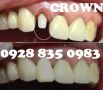 veneers fixed bridge crowns flexible dentures mouth guard for tmj disorder, for teeth grinding, for sports etcrestorationsfillings prophylaxis wisdom tooth removalodontect, -- Medical and Dental Service -- Metro Manila, Philippines