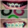 dental brace, -- Dental Care -- Pampanga, Philippines